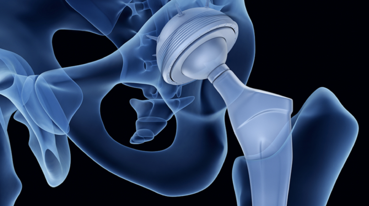 Prótesis de cadera en Irapuato